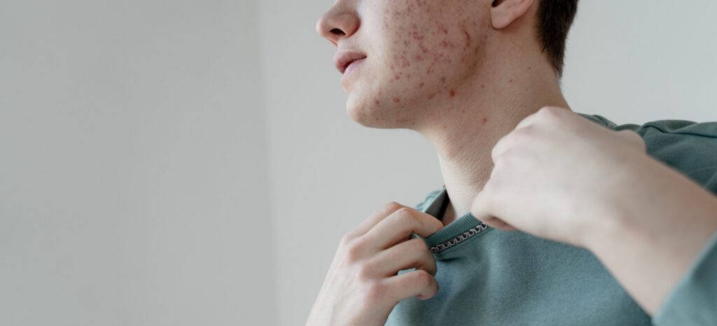 Meth Sores: Causes, Dangers, and Treatment